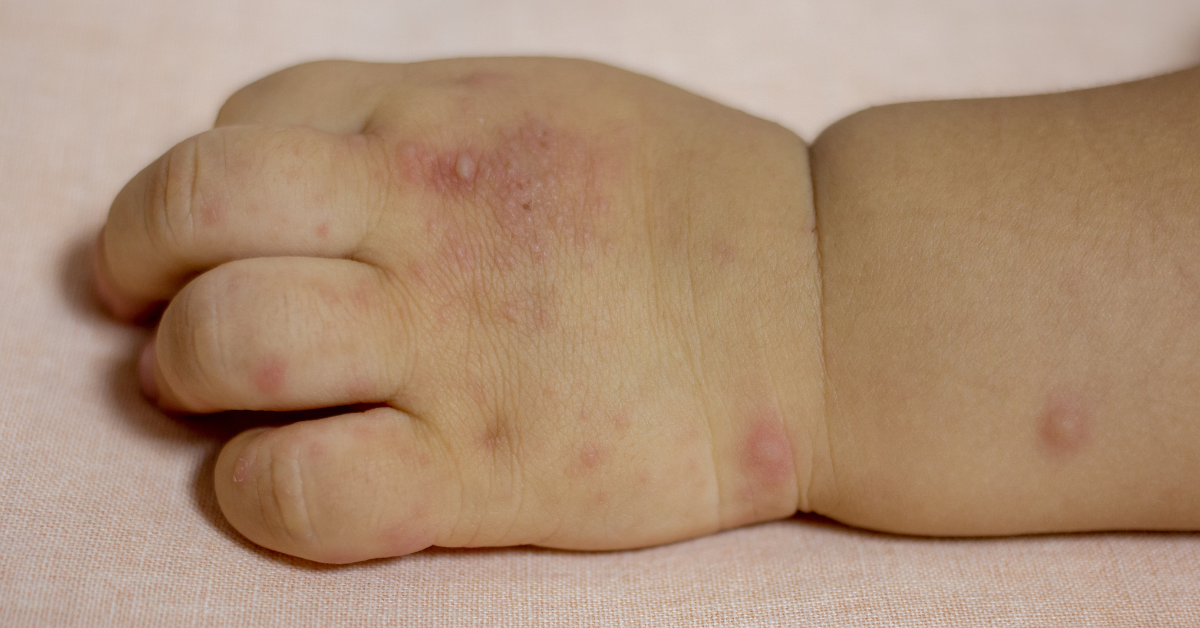 HFMD cases sa QC sumirit ng 722%, karamihan biktima mga bata