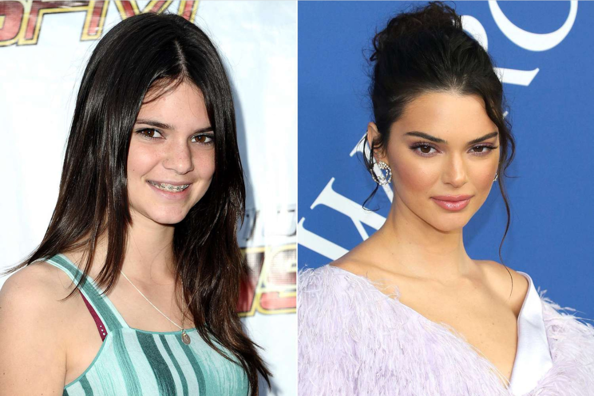 Kendall Jenner, nagsalita na sa isyu ng plastic surgery: “I’ve never had any plastic surgery on my face”