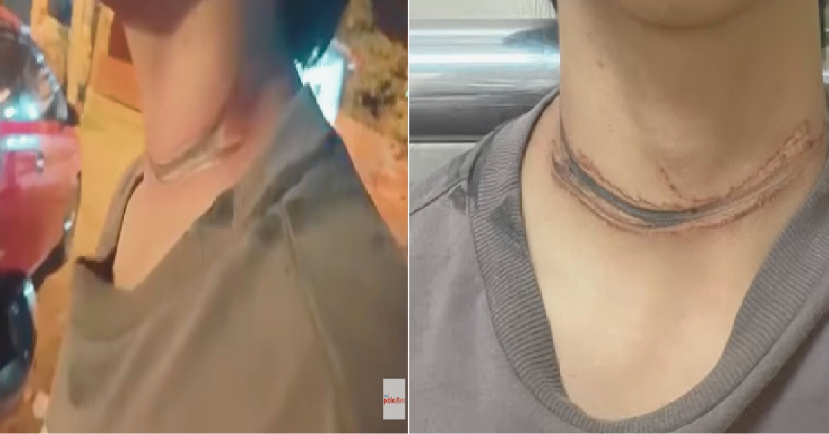 Binatilyo muntik magilitan matapos sumabit sa nakalaylay na kable sa Zamboanga