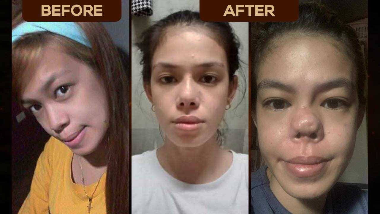 Babae, 4 taon nagdusa sa botched nose job! Raffy Tulfo tumulong