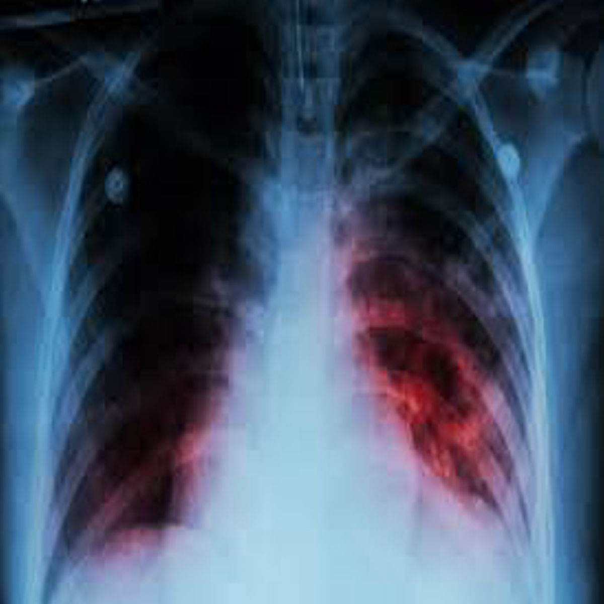 Tuberculosis sa Naga City, patuloy na tumataas; Pinakabatang kaso, 5 taong gulang