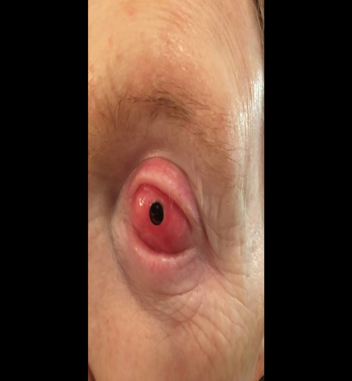 Tooth-Eye Surgery: 75-anyos na babaeng bulag, ginamit ang kanyang ngipin para makakitang muli?